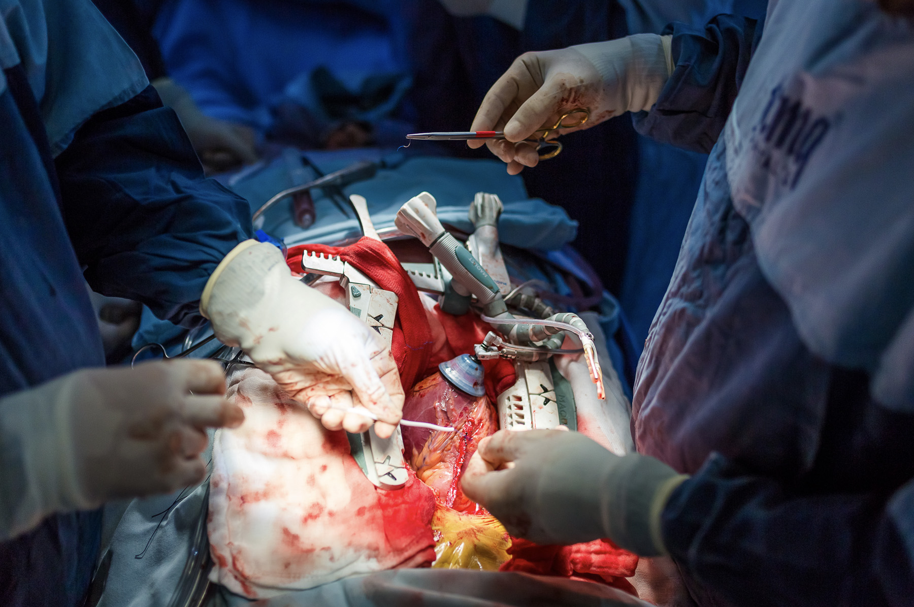 Cirugía de corazón abierto en Hospital CMQ Premiere Puerto Vallarta